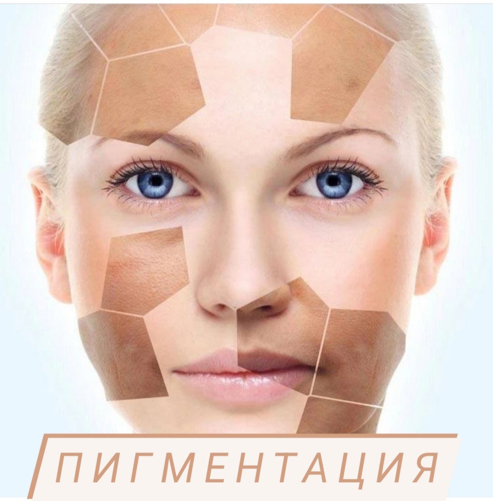 Фотолечение пигментации