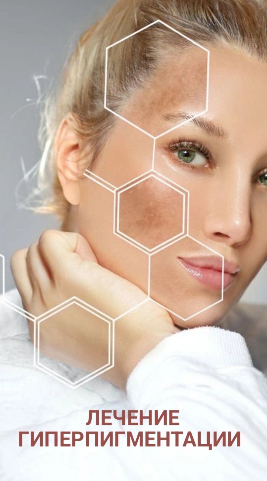 Фотолечение пигментации
